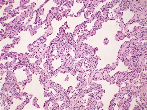 Mild Cylindrical Bronchiectasis Comprehensive Guide To Treatment