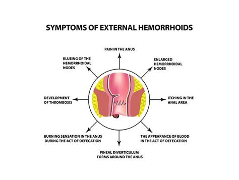 Hemorrhoid Treatment Center In Orange County Orange County Hemorrhoid