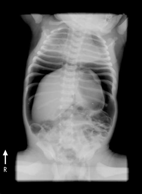 Neonatal Gastric Perforation Following Inadvertent Connection Of Oxygen