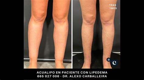 Paciente con Lipedema tratada con liposucción asistida por agua