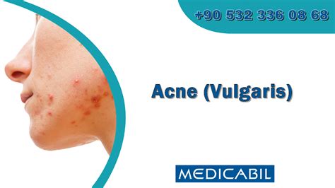 Acne Vulgaris