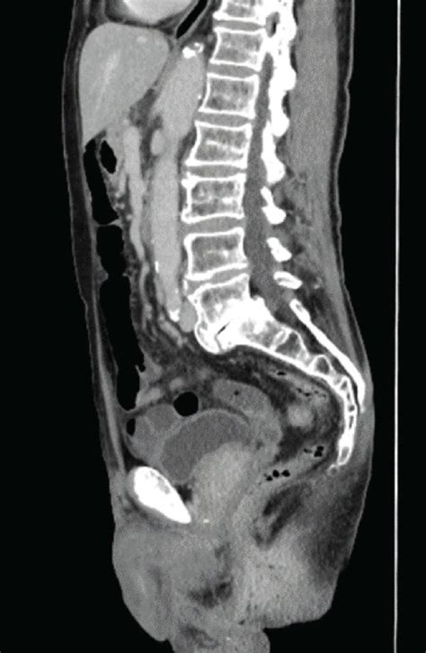 Contrast Enhanced Abdominal Ct Scan Sagittal Section Enhanced