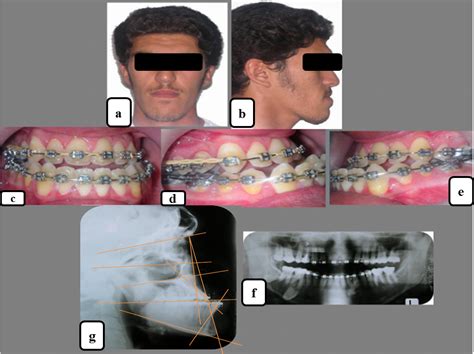 Orthodontic Surgical Correction Of A Skeletal