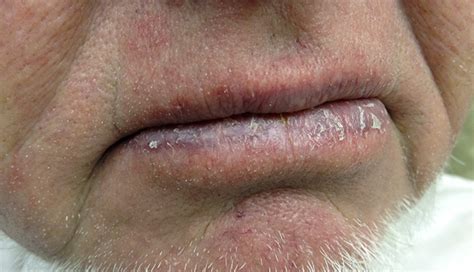 Ectopic Sebaceous Glands Lips Lipstutorial Org