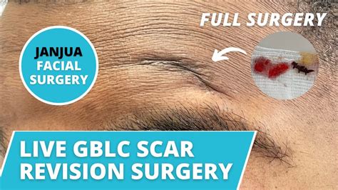 Scar Revision Surgery On Forehead Scar Dr Tanveer Janjua New