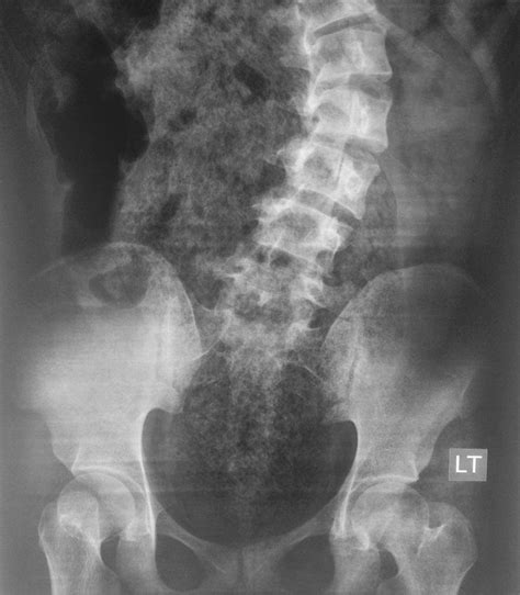 Dr José Efrén on Twitter SIGNOS DE RX CLÁSICOS DE APENDICITIS Nivel