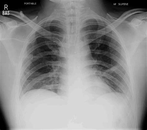 Approach To The Chest X Ray Cxr Medicine Libretexts