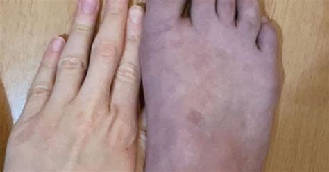 Feet Go Purple With White Blotches