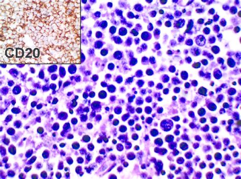 Paraffin Section Of Nonhodgkin Lymphoma Showing Monomorphic Round To