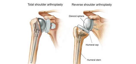 Shoulder Replacement Dr Atul Patil