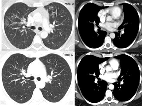 Chest Ct Scan Images Lung Windows Panel A And C And Mediastinal Download Scientific Diagram