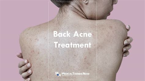 How To Get Rid Of Back Acne Causes Treatments Tips Atelier Yuwaciaojp