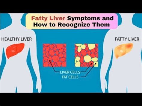 Fatty Liver Symptoms And Early Signs Of Fatty Liver Disease : r ...