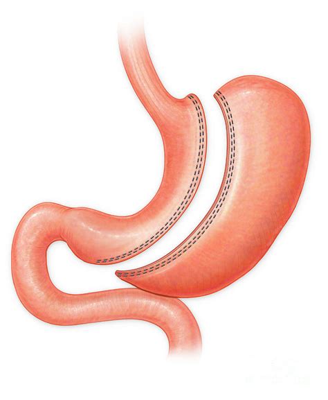 Sleeve Gastrectomy Procedure Photograph By Medical Imagery Studios