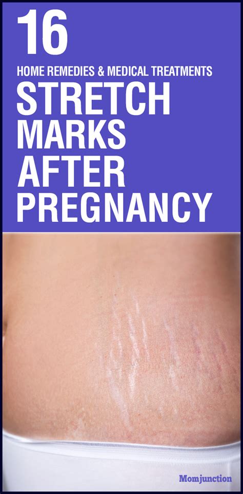 How To Remove Stretch Marks After Pregnancy 16 Home Remedies