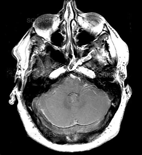 Photograph | Extensive Dural Sinus Thrombosis, MRI | Science Source Images