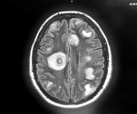 Nocardia Abscesos Cerebrales Y Cisticercosis Mri Cerebro Con Contraste