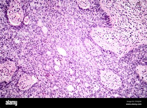 Fotomicrografía Del Carcinoma Basocelular Que Muestra Células Basales