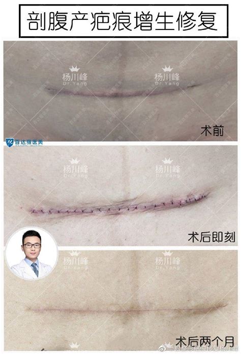 剖腹产后肚子上的疤痕如何去除？ 知乎