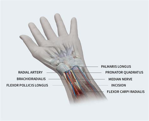 Distal Radius Fracture Fixation - Avanti