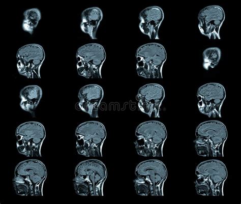 Proyecci N De Imagen De Resonancia Magn Tica Cabeza Del Mrt De Mri