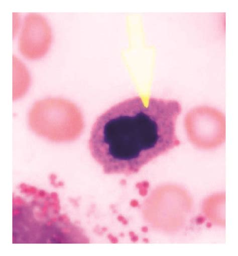 Bone Marrow Aspirate Biopsy Metaphases Cytogenetic And Response To