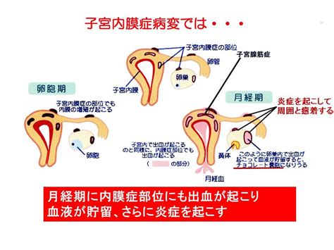 子宮内膜症とは？ よくあるご質問 徐クリニック