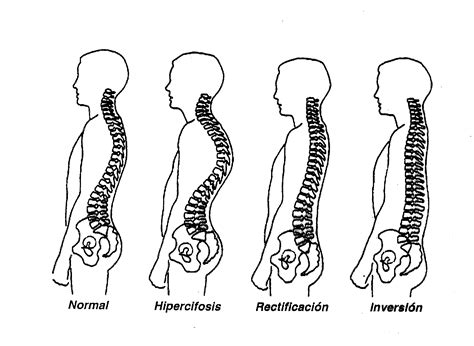 Alteraciones De La Postura En El Plano Sagital Otosection