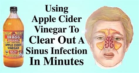 How To Clear Out A Sinus Infection Within Minutes Drinking 2 Tbsp Of Apple Cider Vinegar