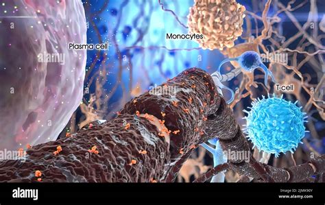 Mieloma múltiple un tipo de cáncer compuesto por un tipo de glóbulo