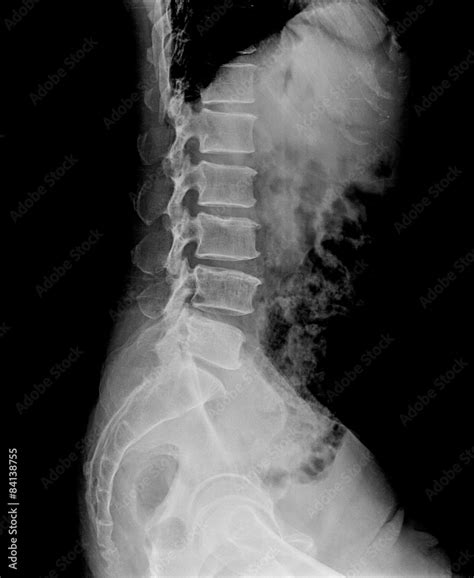 Lumbar Vertebrae Anatomy Xray