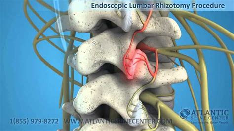 Endoscopic Facet Rhizotomy Atlantic Spine Center