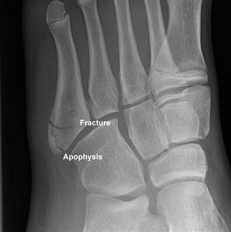 Base Of 5th Metatarsal Fracture And Apophysis This Case Illustrates