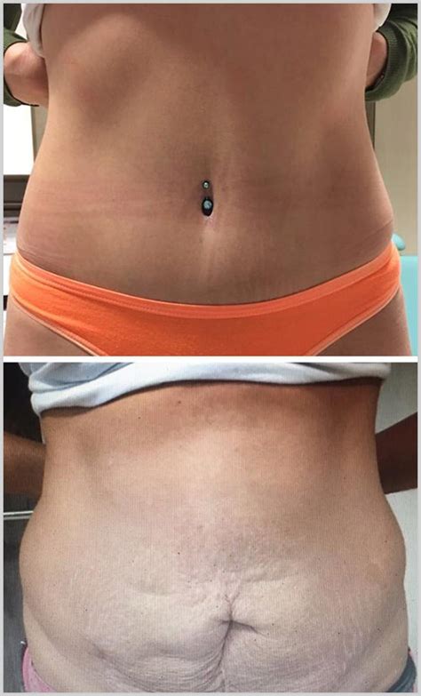 Abdominoplasty Tummy Tuck Turkey Dental Clinic Turkey