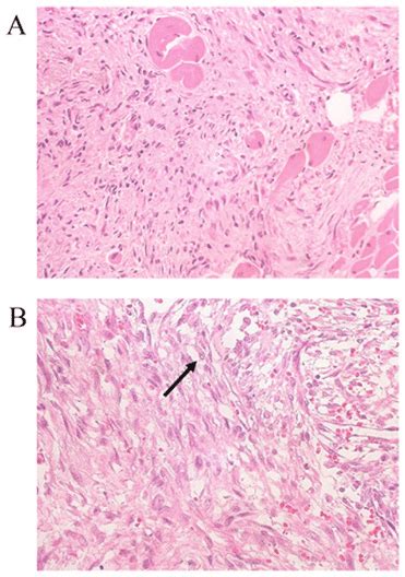 Histological Results Of The Case A The Lgms Tumor Cells Were