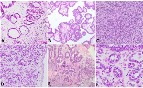 Clear Cell Adenocarcinoma Of The Lower Urinary Tract Demonstrates