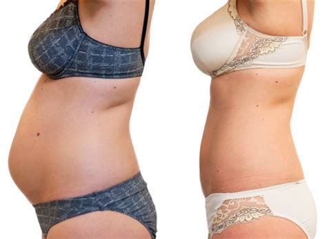 Abdominoplastia O Lipectom A Abdominal Omar Sinue Burgos Cirujano