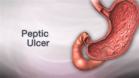 Causes And Remedies For Stomach Ulcers - Verna Magazine