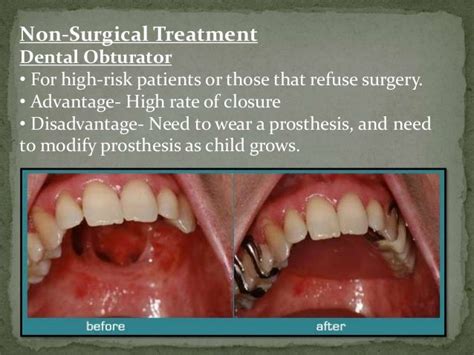 Cleft palate dental oral pathology