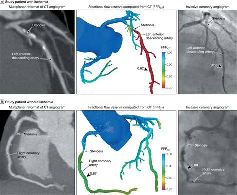 Diagnostic Accuracy Of Fractional Flow Reserve From Anatomic Ct