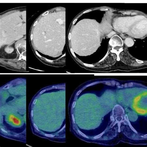 A Abdominal CT Showing Complete Remission Of Liver Metastases CT