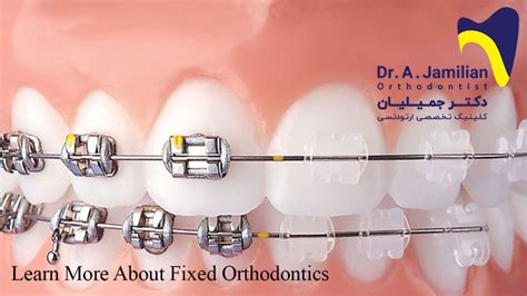 Learn More About Fixed Orthodontics Dr Jamilian