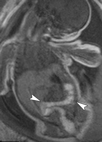 Fetal Mr Imaging Of Gastrointestinal Abnormalities Radiographics