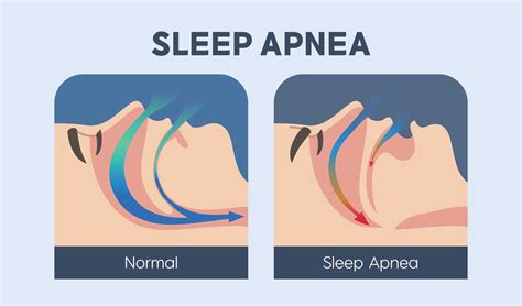 What Is Sleep Apnea Tmj Sleep Apnea