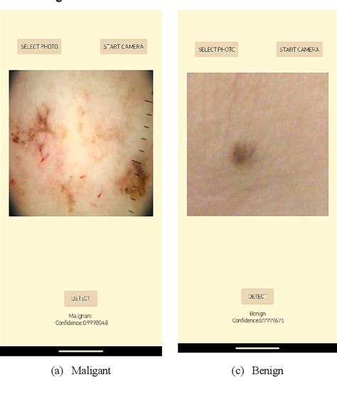 Figure From Early Detection And Classification Of Melanoma Based On