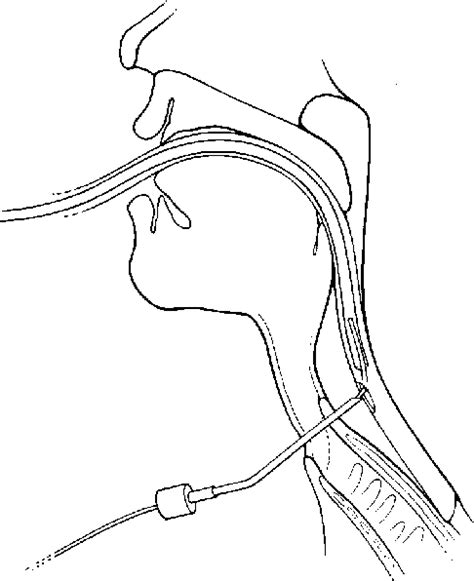 Figure 1 From Using An Endotracheal Tube In Difficult Secondary