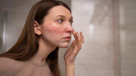 Mengenal Rosacea Gangguan Kulit Wajah Yang Ditandai Dengan Kemerahan