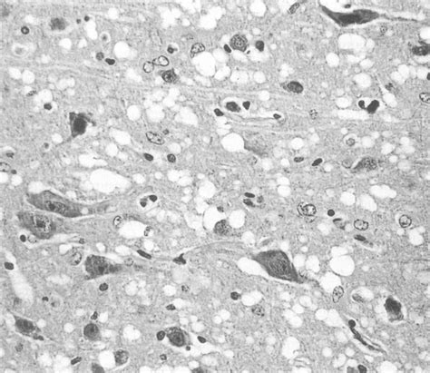 Neuropil Vacuolation Of Superior Frontal Gyrus With Neuronal