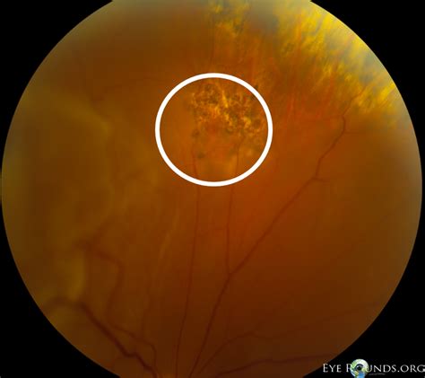 Atlas Entry Retinal Breaks Holes With Proliferative Vitreoretinopathy