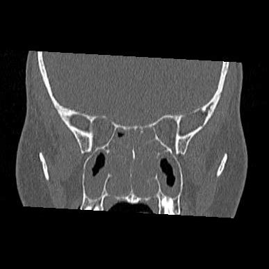 Sinonasal Polyposis With Small Ethmoidal Osteoma Image Radiopaedia Org